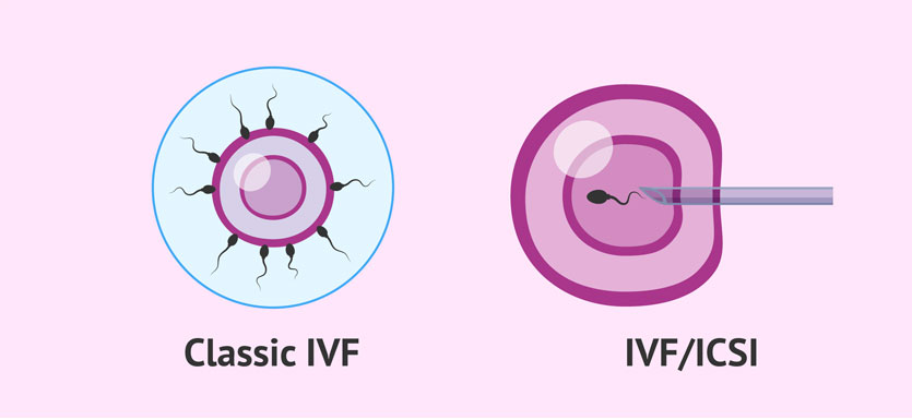 Is ICSI more expensive than traditional IVF?