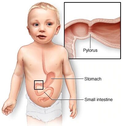 What are the symptoms of Infantile Hypertrophic Pyloric Stenosis?