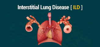 What are the common symptoms of Interstitial Lung Disease?