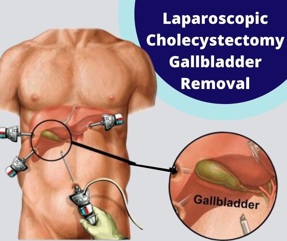 Gallbladder removal surgery in mumbai