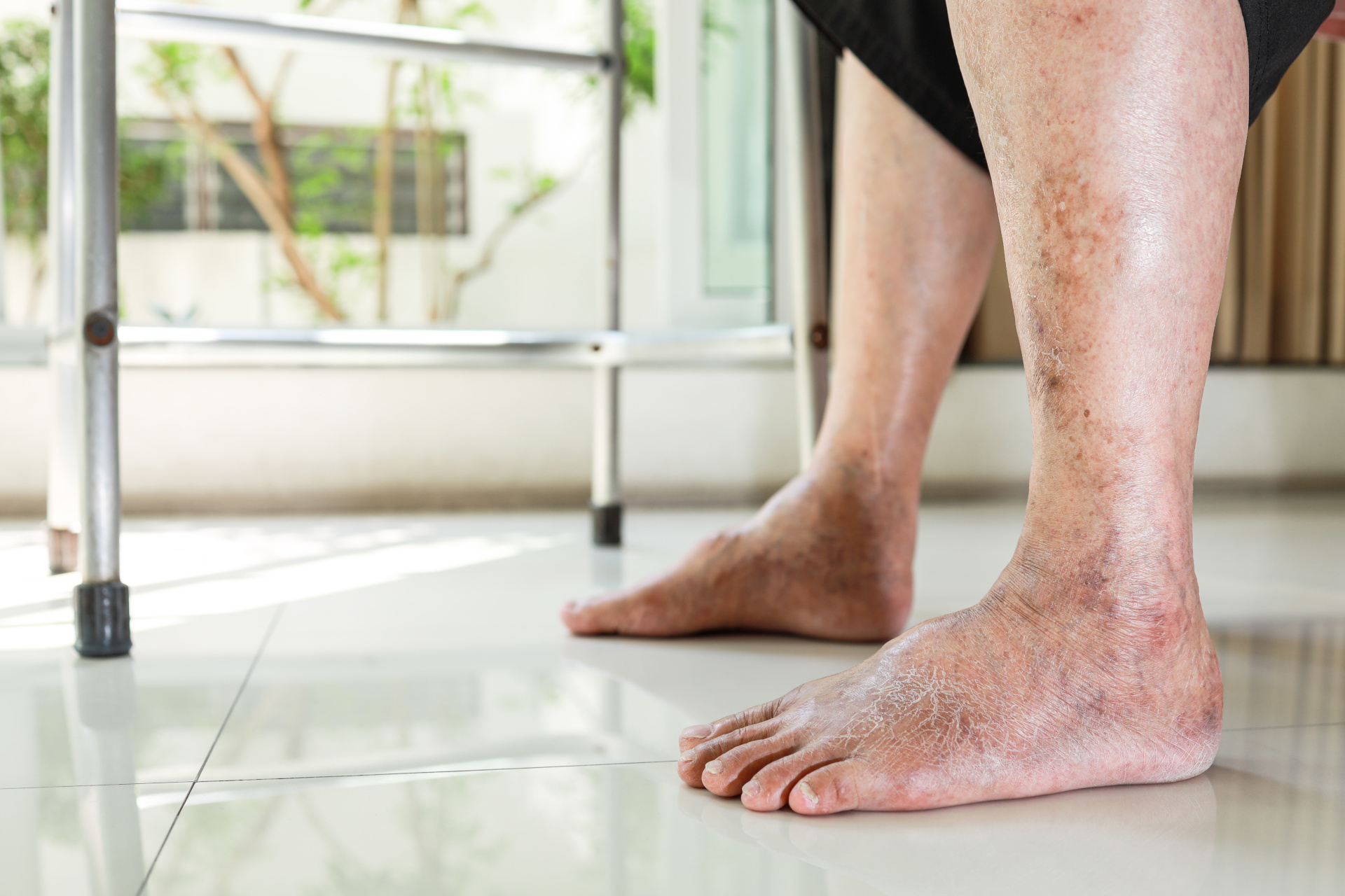 Peripheral Vascular Disease Treatment in Mumbai | Dr. Kunal Arora