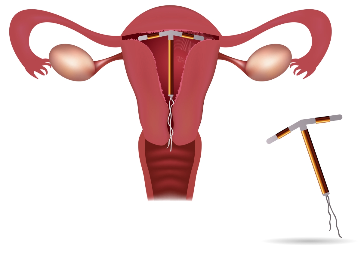 Can I get pregnant after the removal of a retained IUD?