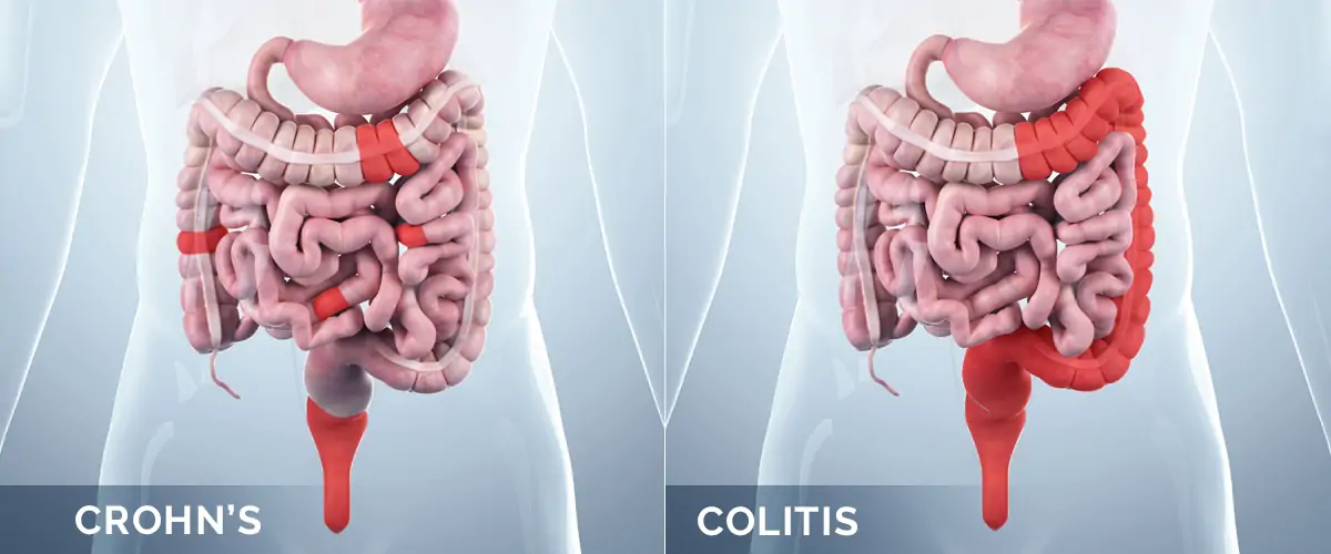 Crohn’s Disease Treatment Mumbai | Dr. Chintamani