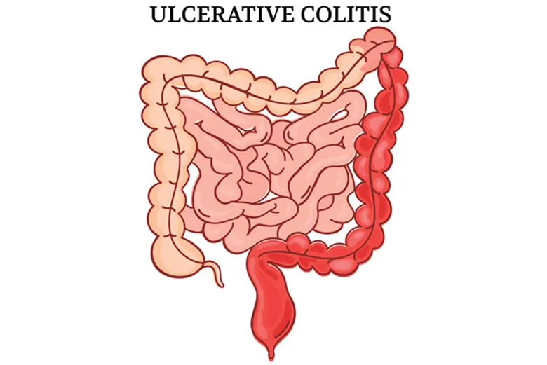 What are the symptoms of Ulcerative Colitis?