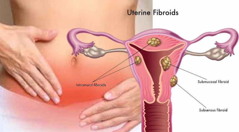 Are there non-surgical treatment options for uterine fibroids, and how effective are they?