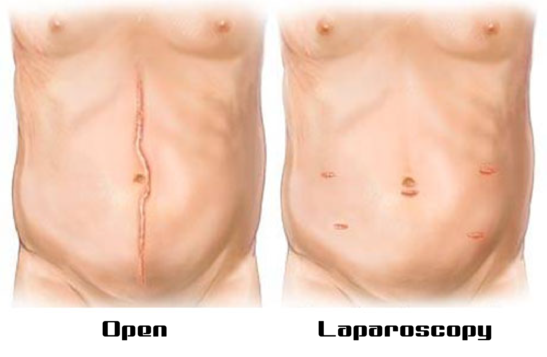 How is the Choice Between Open and Laparoscopic Surgery Made?