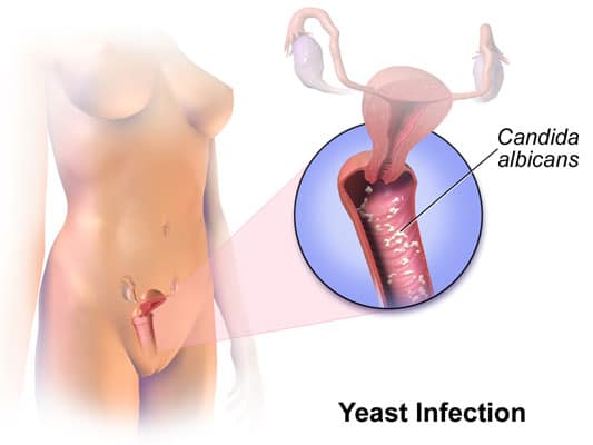 Can certain foods or dietary habits worsen vaginal infections?