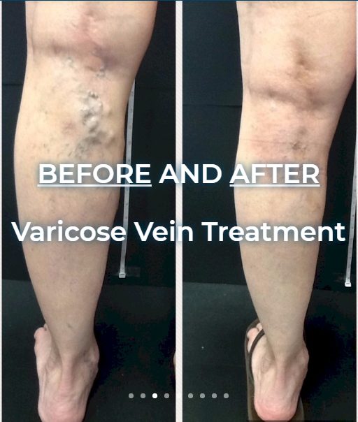 How soon can one return to normal activities after varicose vein treatment?