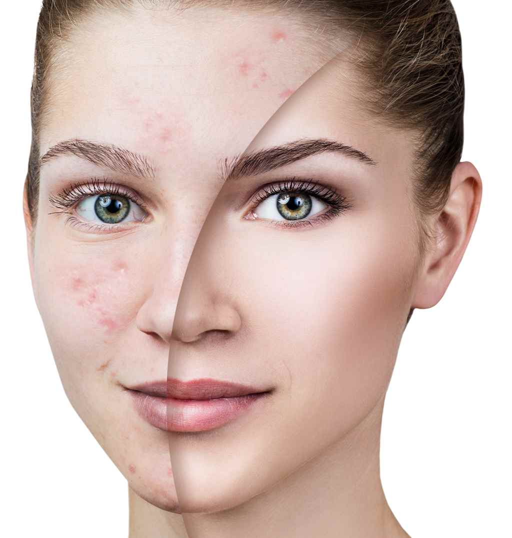 What innovative or emerging treatments are available for acne?