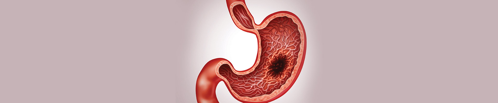 BEST STOMACH CANCER TREATMENT IN MUMBAI