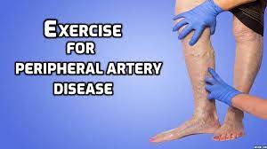 Can exercise help manage Peripheral Vascular Disease?