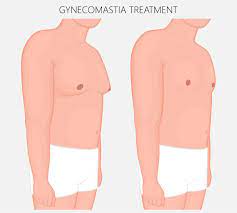 What are the treatment options for Gynecomastia?