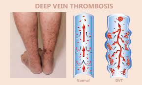 Deep Vein Thrombosis Treatment in Mumbai | Endovascular Care Centre