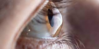 What is keratoconus, and how is it treated?