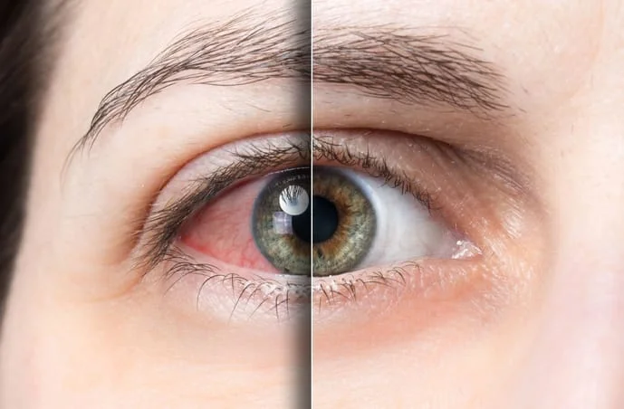 Dry Eye Checkup Treatment in Andheri