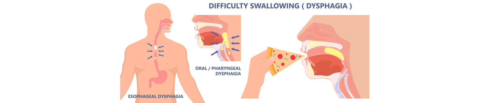 Dysphagia treatment in Mumbai | Globus Hospital