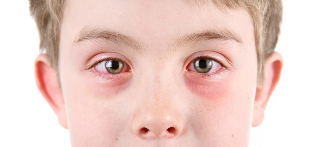 Can Allergies Contribute to Dry Eye Syndrome?