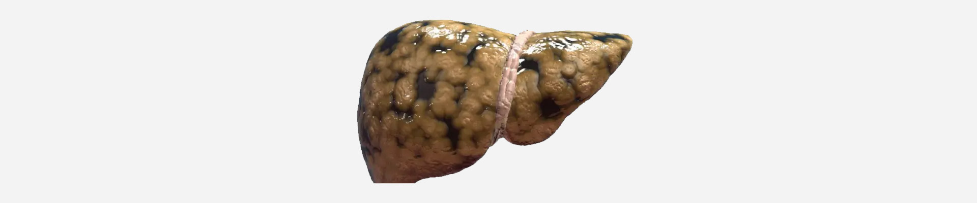 https://globushospital.in/fatty-liver.html