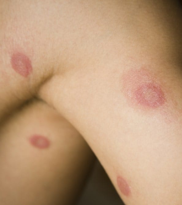 Fungal infection treatment in mumbai