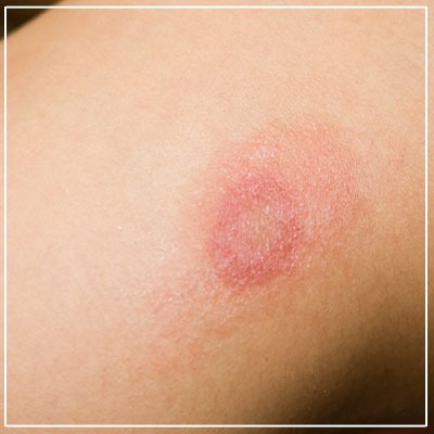 Fungal infection treatment in Mumbai | Fungal skin infection | Viva aesthetic