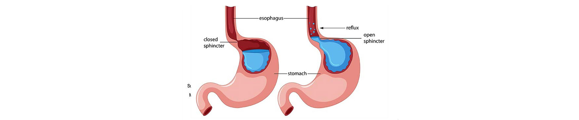 Gerd Treatment in Mumbai