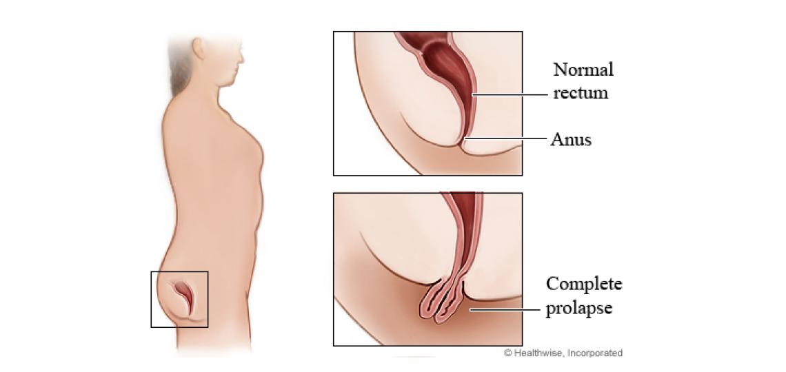 Can rectal prolapse be treated without surgery?