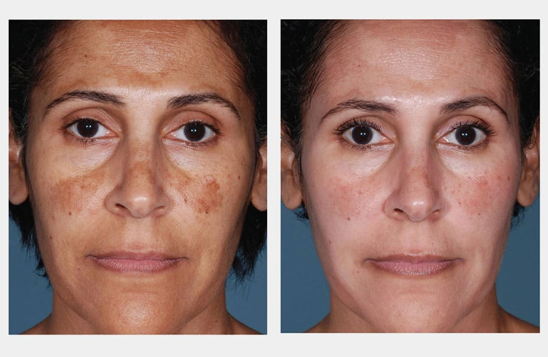 Skin Pigmentation Treatment in Mumbai