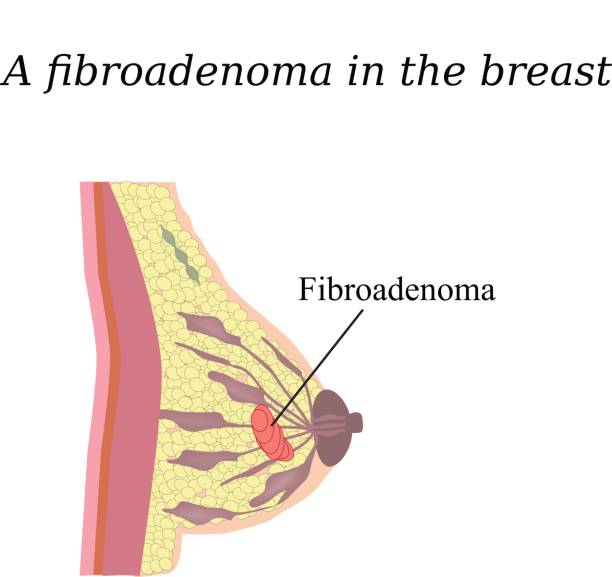 What are the benefits of Oncoplastic Breast Surgery for Fibroadenomas?