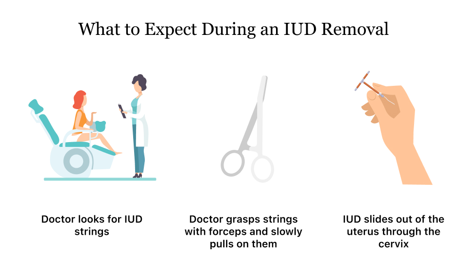 Is the removal of a retained IUD a complex procedure?