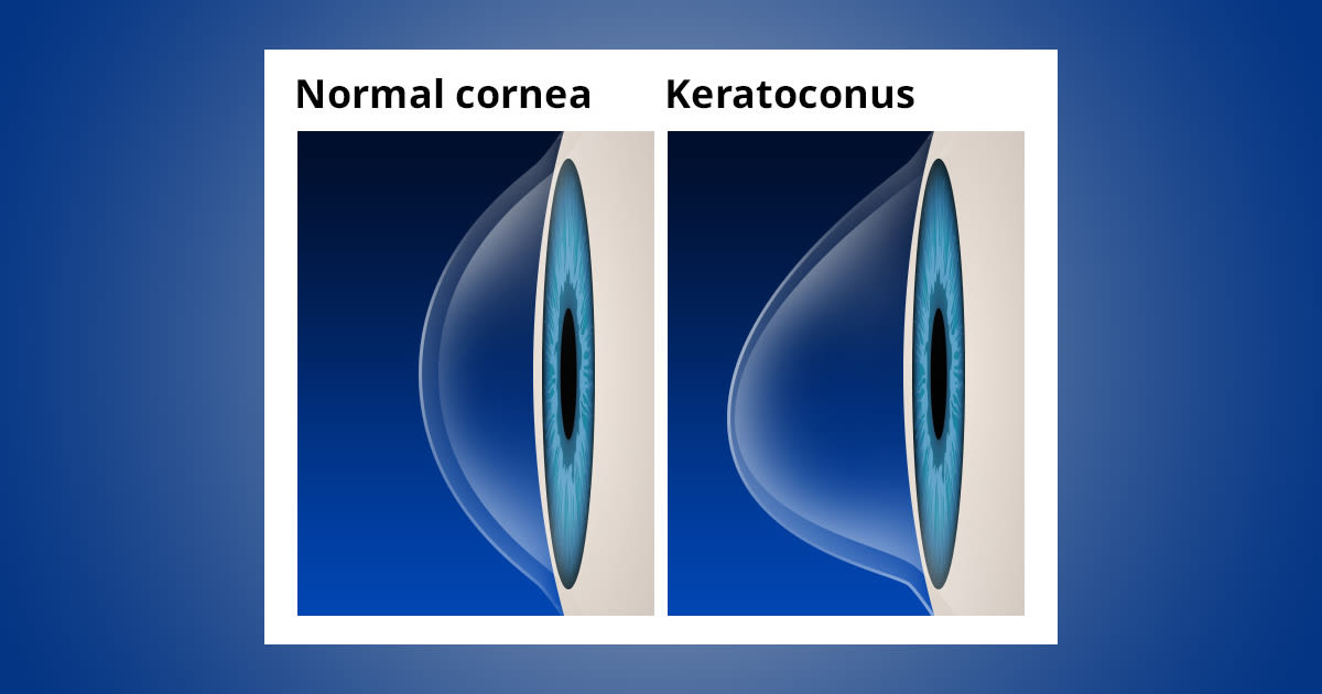 What are the available treatment options for Keratoconus?