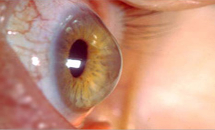 keratoconus Treatment in Andheri Mumbai | Smart Vision Eye Centre