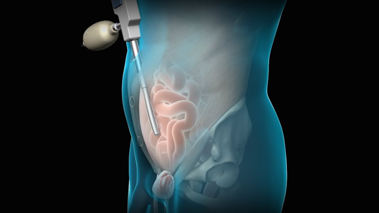 Laproscopic Hernia Surgery in Mumbai