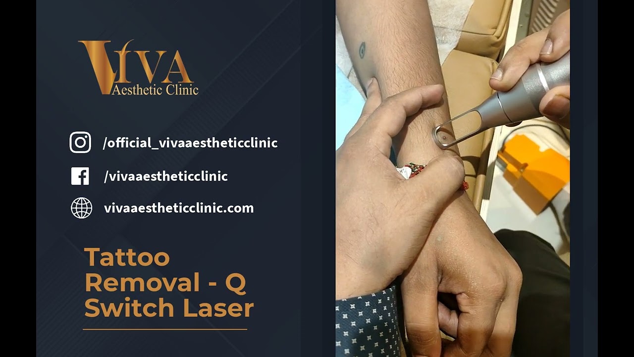 Tattoo Removal | Q Switch Laser Treatment | Dr. Deepam Shah | Dermatologist in Mumbai