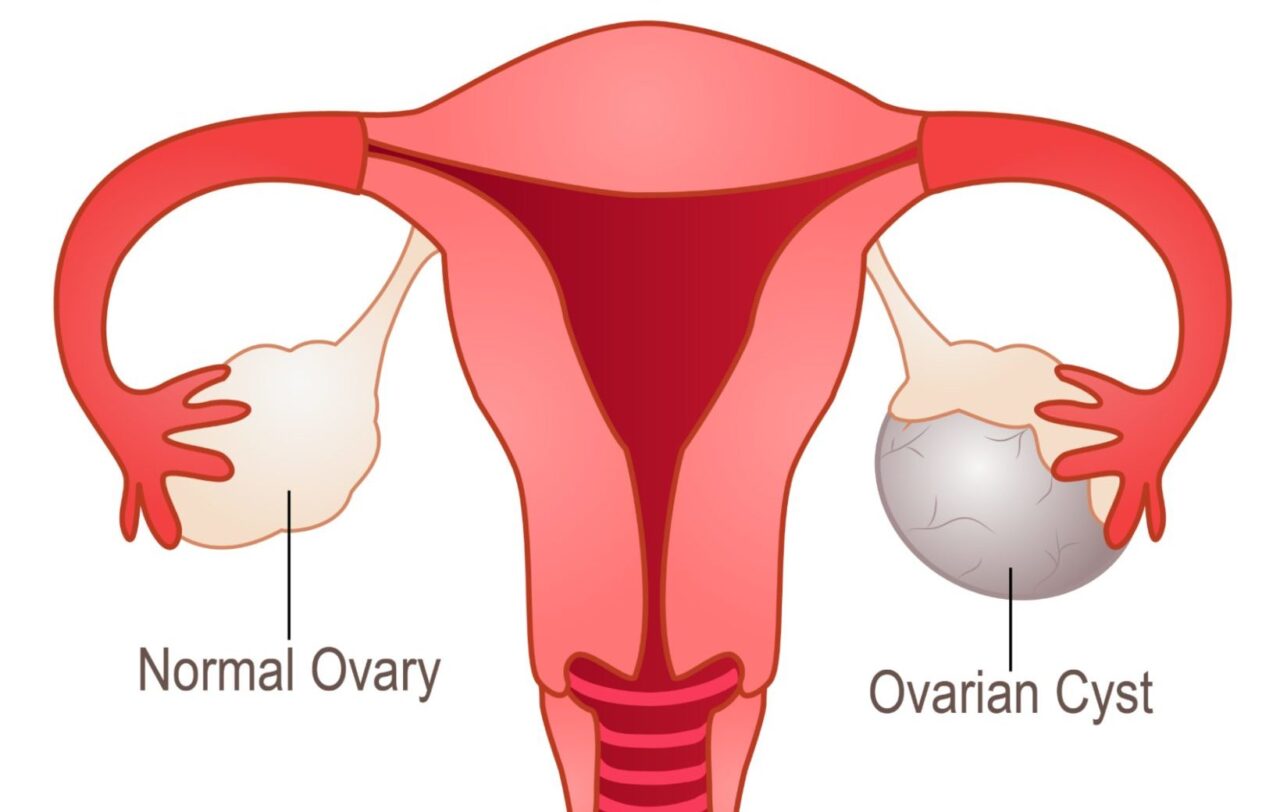 Is ovarian cystectomy performed laparoscopically?