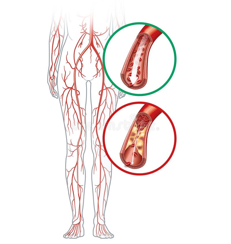 How can one prevent Peripheral Vascular Disease?