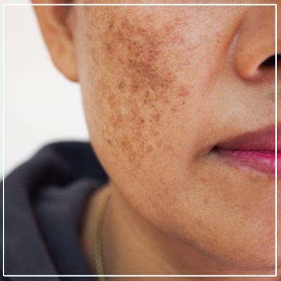 Skin Pigmentation Treatment in Mumbai | Viva Aesthetic Clinic