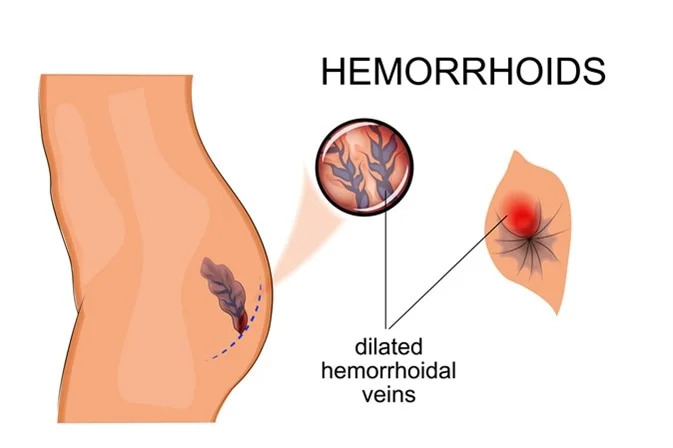 When is surgery for hemorrhoids recommended, and what procedures are used?