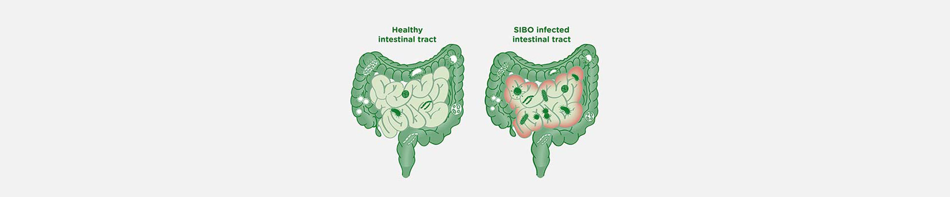 SIBO Treatment in Mumbai | Globus Hospital