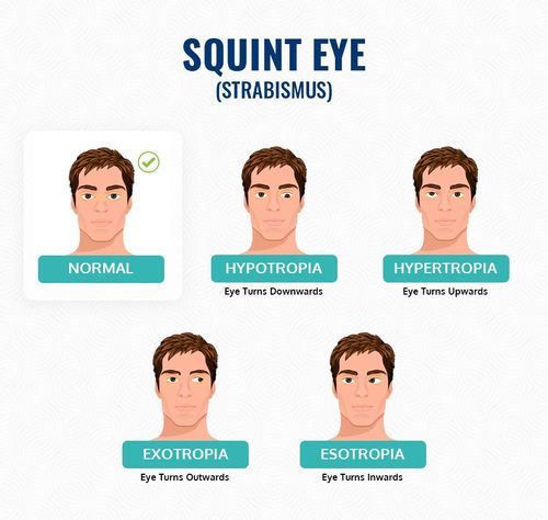 Can Squint Eye Cause Vision Problems?