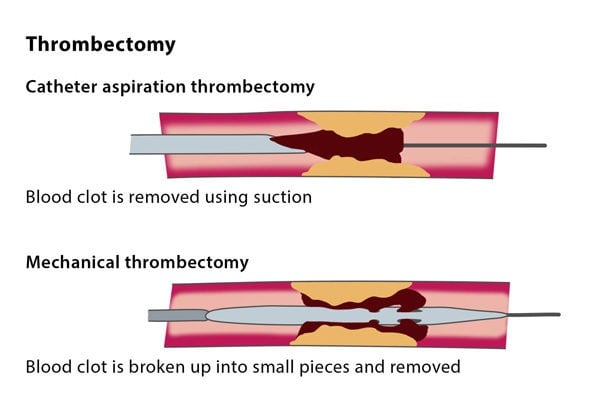 What are the risks associated with thrombectomy?