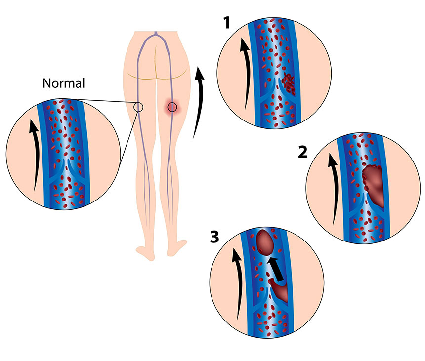 Can dehydration be a risk factor for DVT?