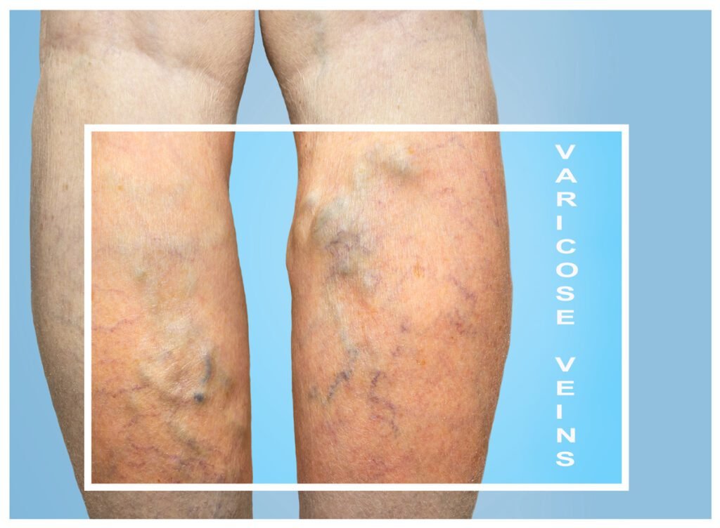 Are varicose veins dangerous? Doctor Near Me