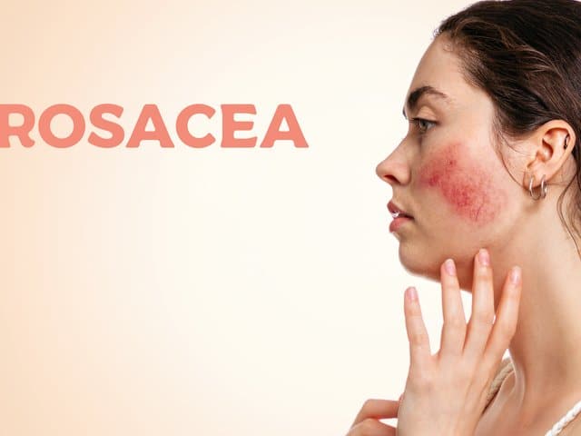 Can Skincare Products Aggravate Rosacea?