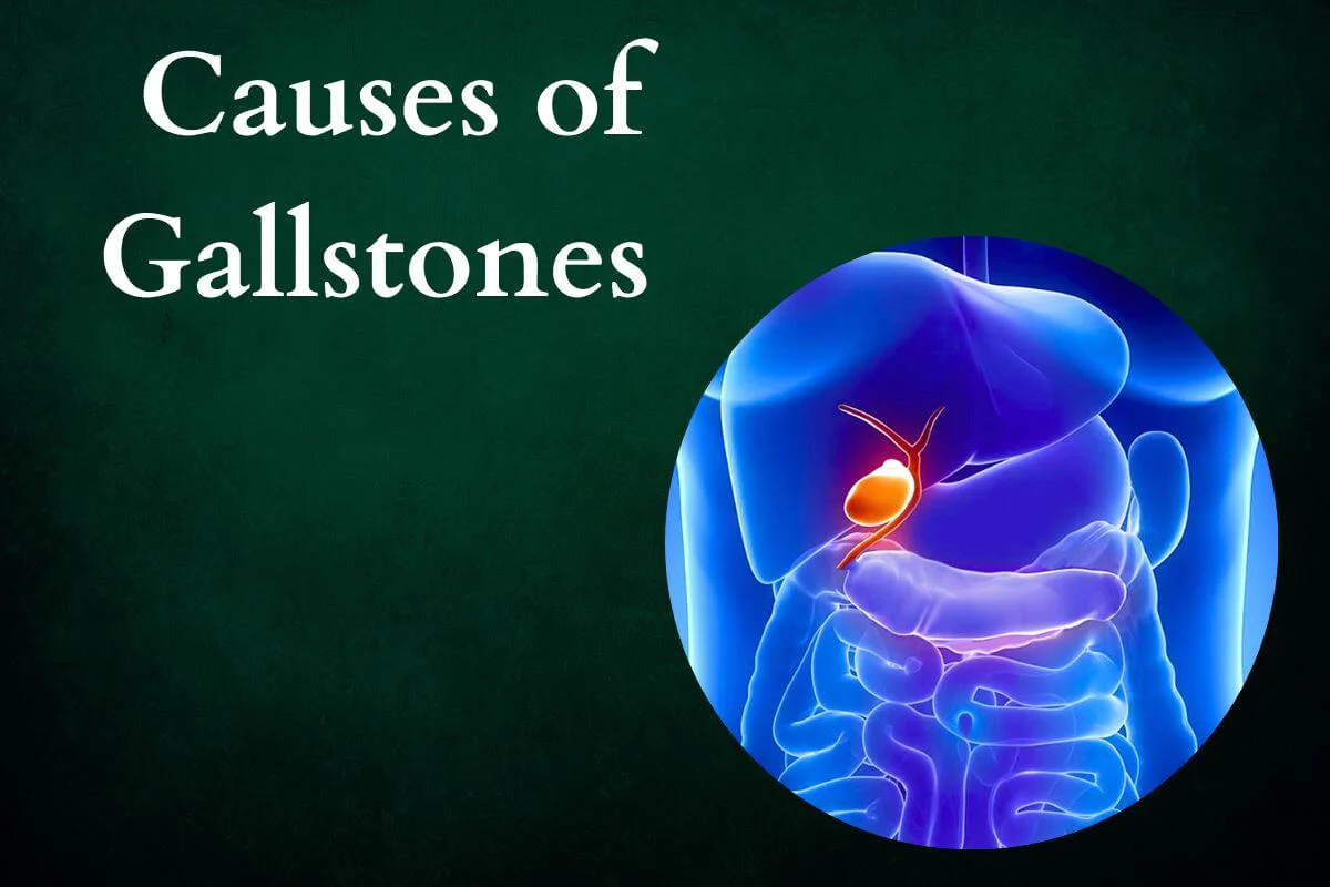 Unlocking Gallstone Causes with Dr. Vedant Karvir: Your Path to Informed Well-being.