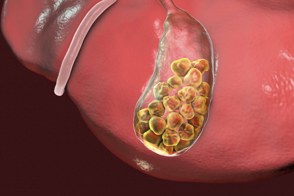 Choosing Gallstone Treatment in Mumbai: Key Considerations!