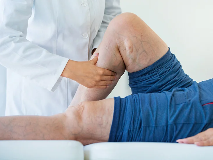 How long does treatment for deep vein thrombosis typically last?