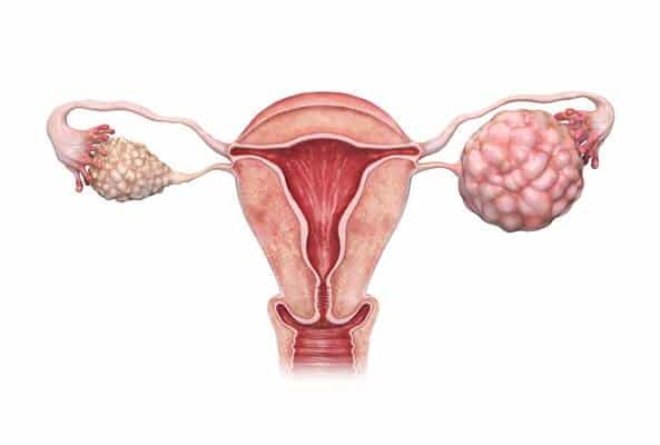 Ovarian Tumor Treatment in Thane | Dr. Arohi Tasgaonkar