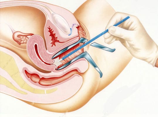 Pap smear test in thane