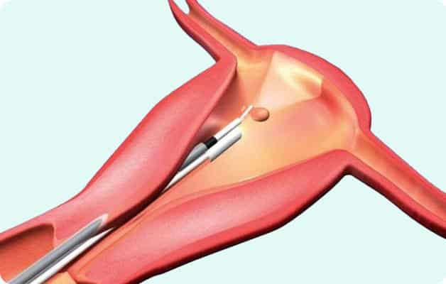 Pre IVF Hysteroscopy in Thane