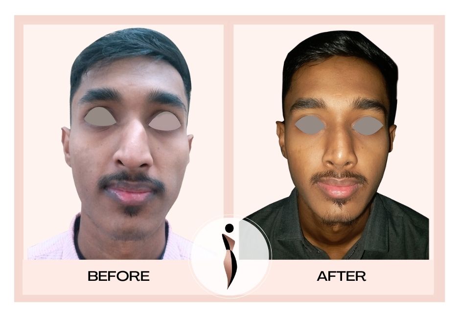 Nose Job Surgeon | Dr. Amiti Shah